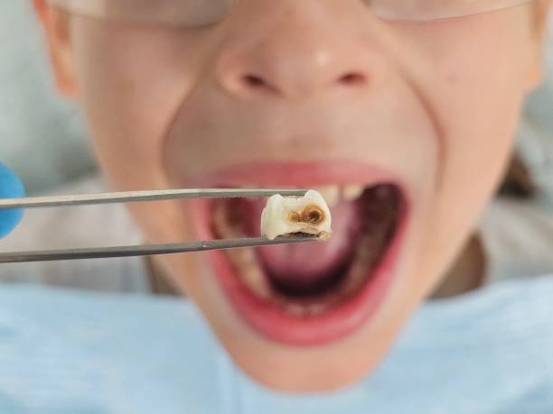 Best Emergency Root Canal Treatment in Flower Mound, TX