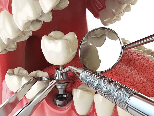Best Emergency Dental Care for Broken or Chipped Teeth in Flower Mound, TX